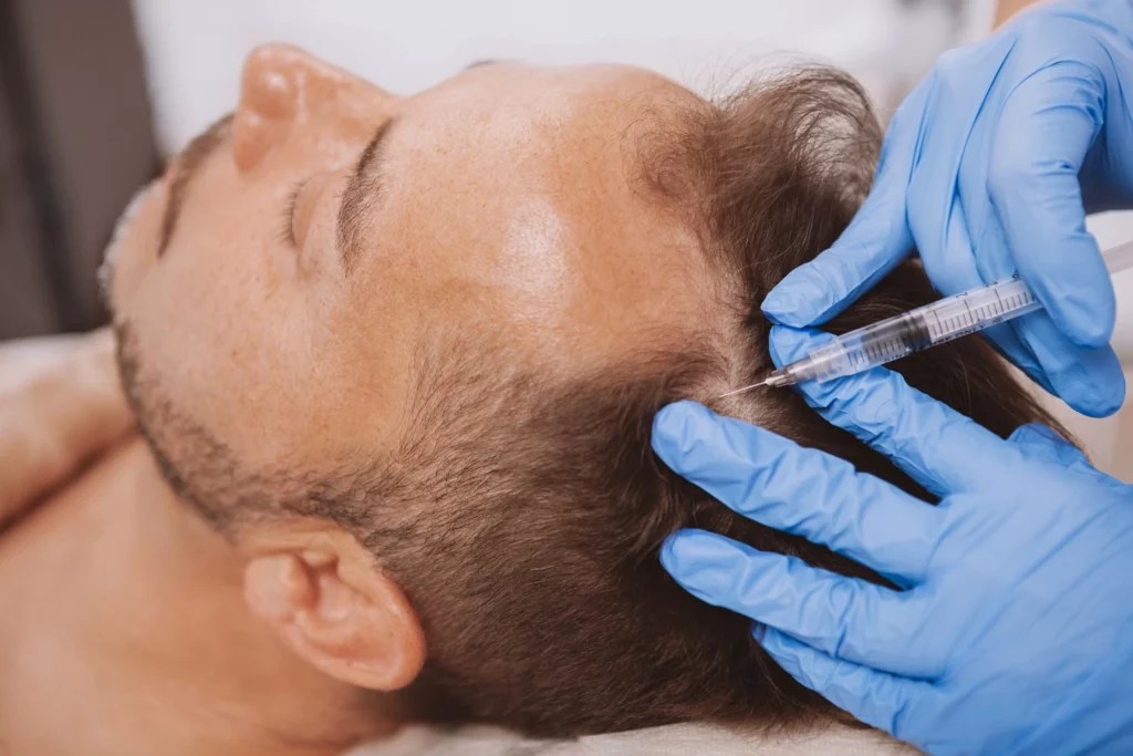 Hair Restoration in Suwanne, GA