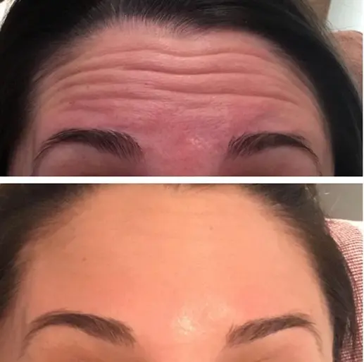 botox 4