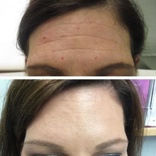 botox 5