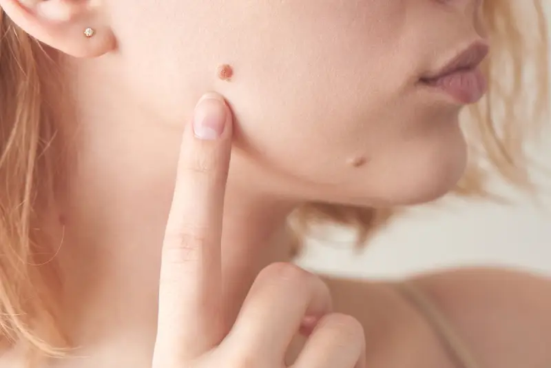 Quick & Effective Cryopen Skin Tag Removal - What to Expect