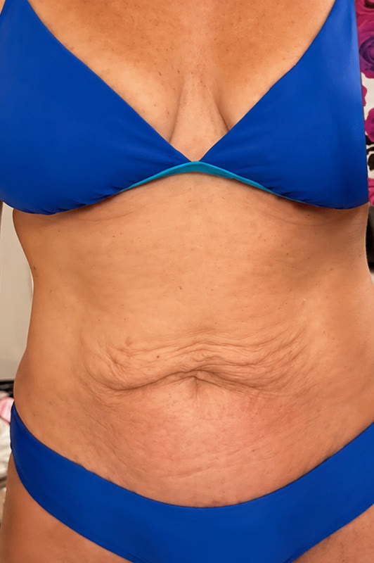 Skin Removal 3 Kara before: loose skin on her stomach