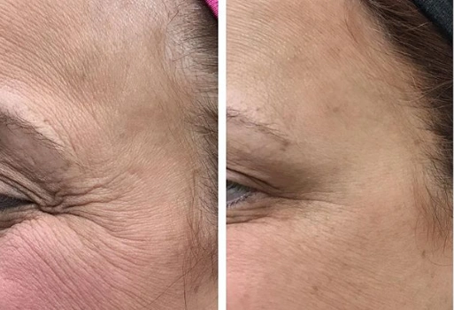 Dysport Treatments in Suwanee, GA