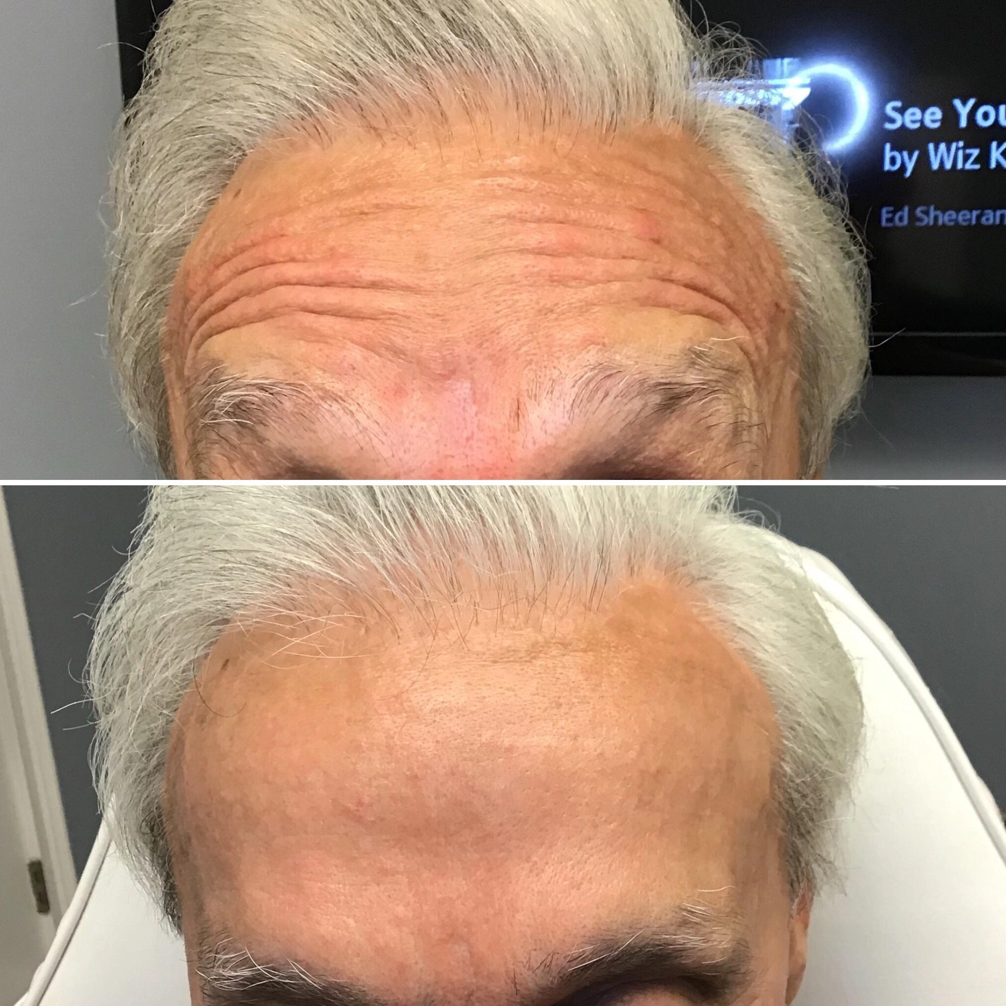 Dysport Treatments in Suwanee, GA