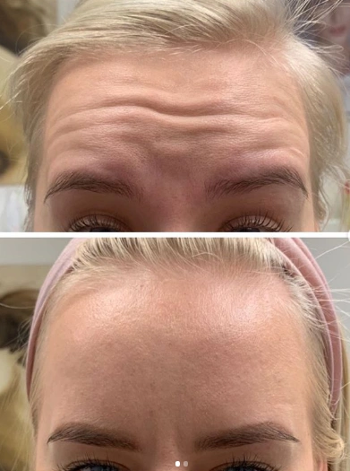 Dysport Treatments in Suwanee, GA