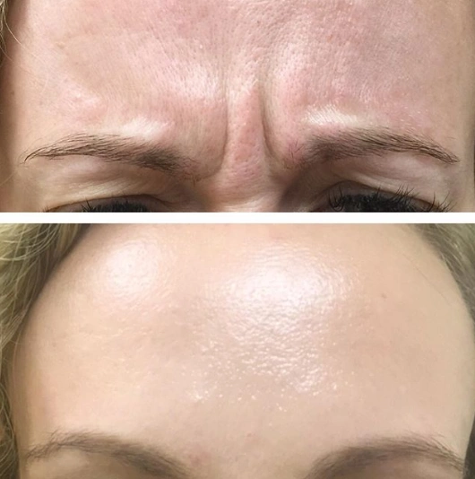 Dysport Treatments in Suwanee, GA