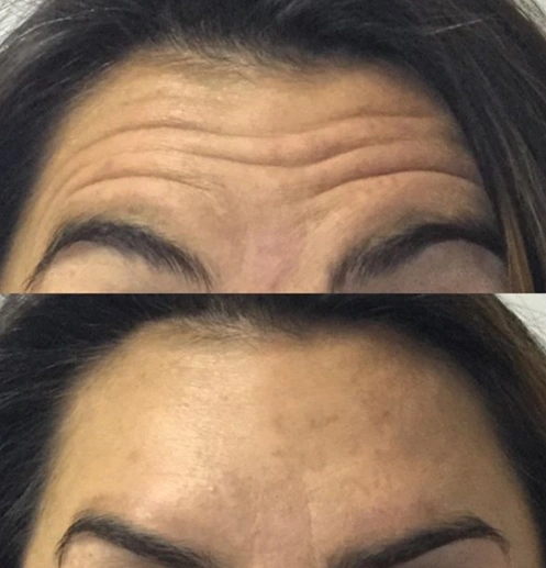 Dysport Treatments in Suwanee, GA